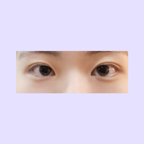 눈재수술 후기