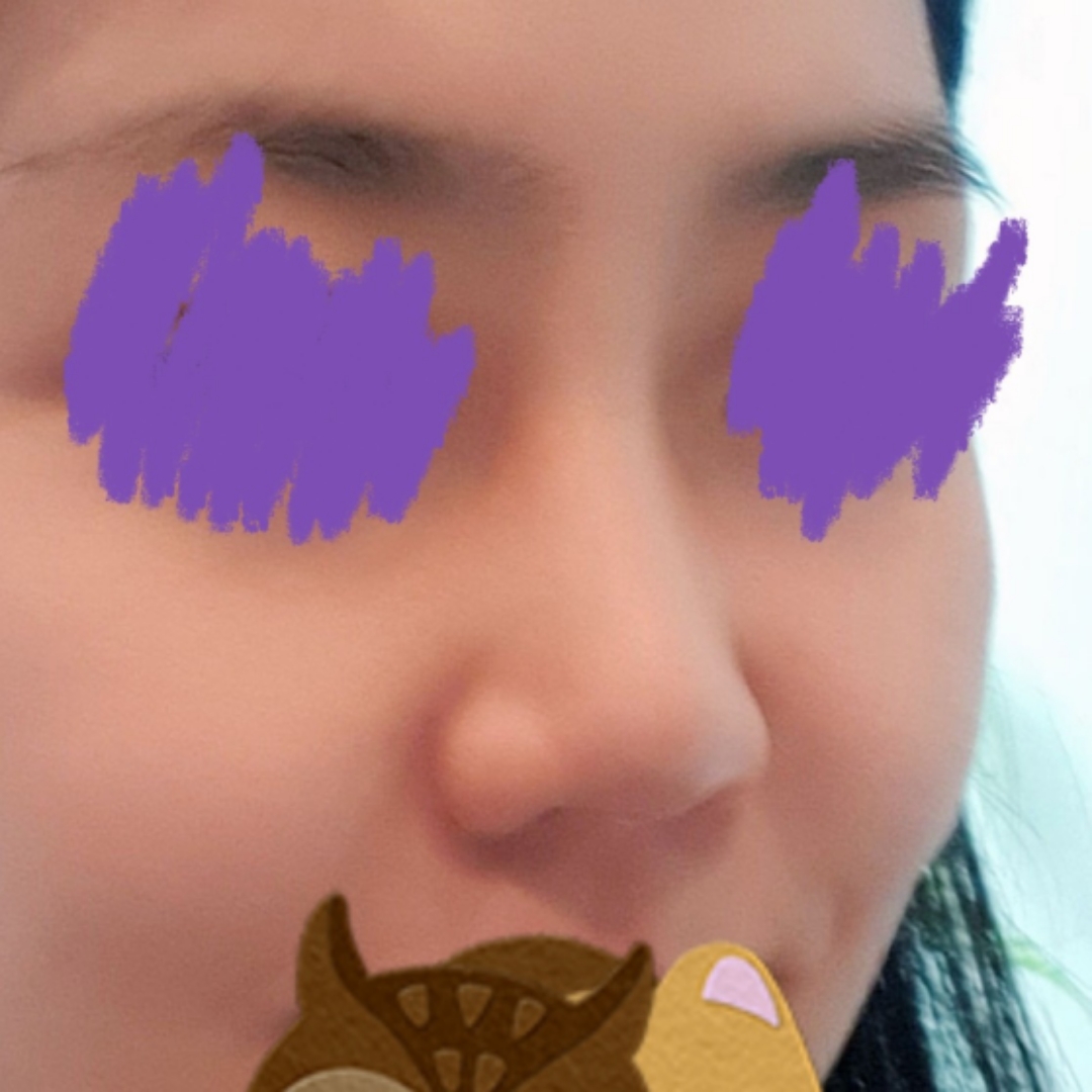 코재수술 후기