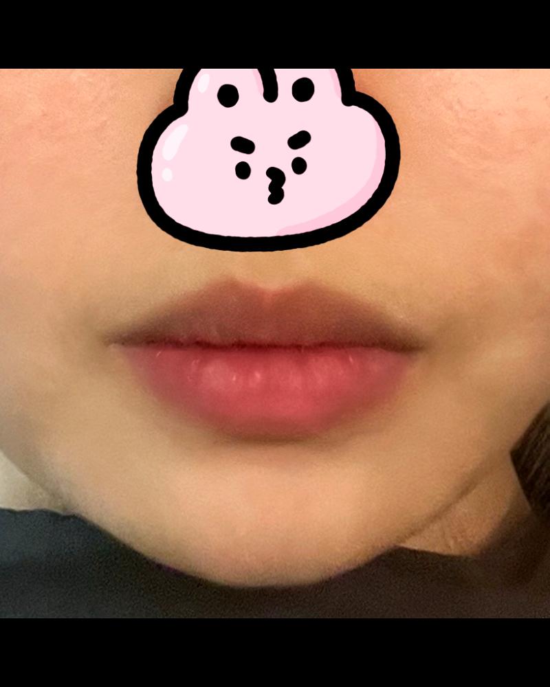 입꼬리성형 후기