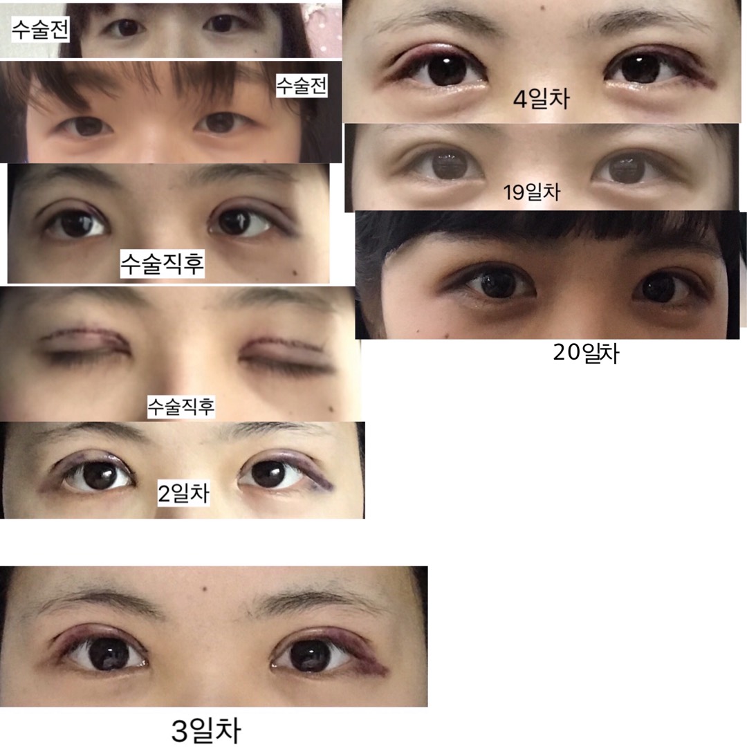쌍꺼풀(절개) 후기