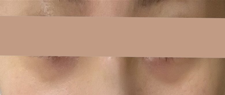 눈밑지방재배치 후기