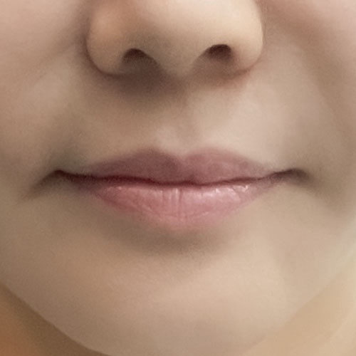 입꼬리성형 후기