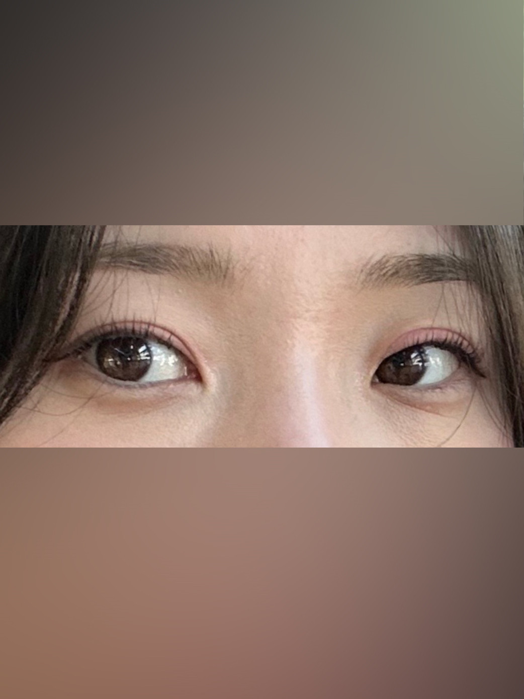 눈재수술 후기