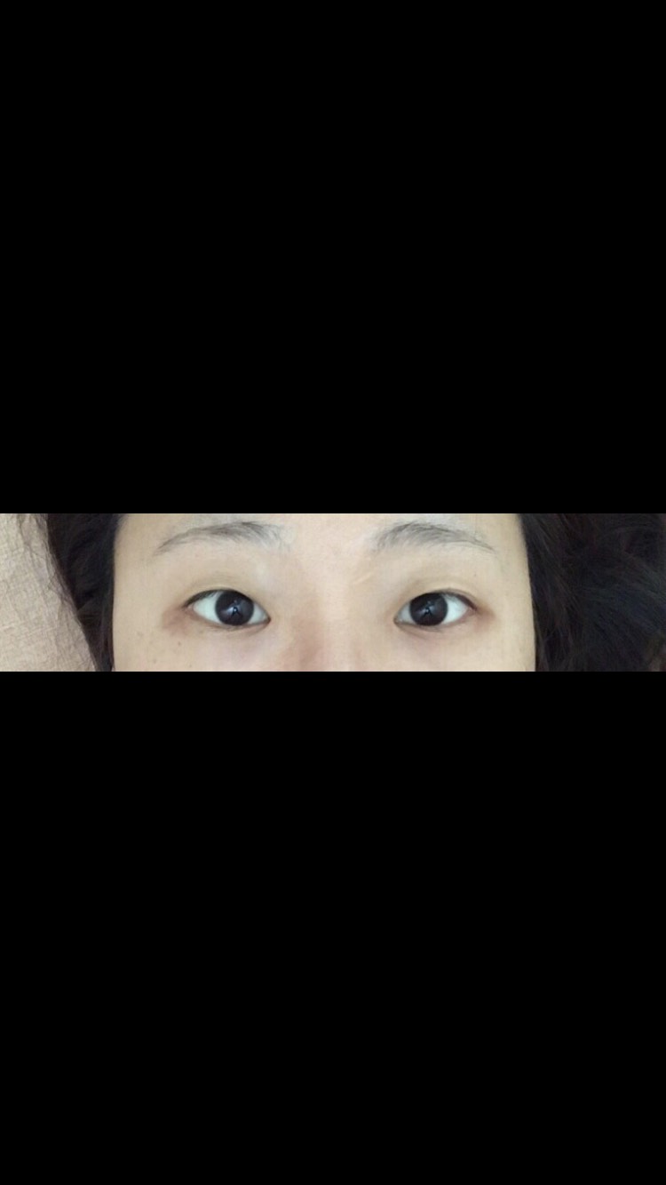 쌍꺼풀(절개) 후기