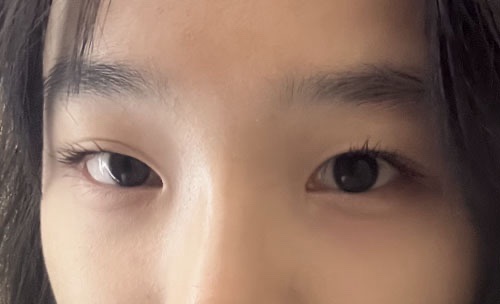 쌍꺼풀(자연유착) 후기