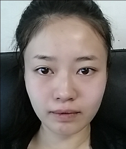 콧볼보톡스 후기