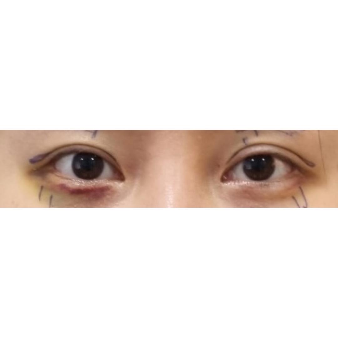 눈재수술 후기