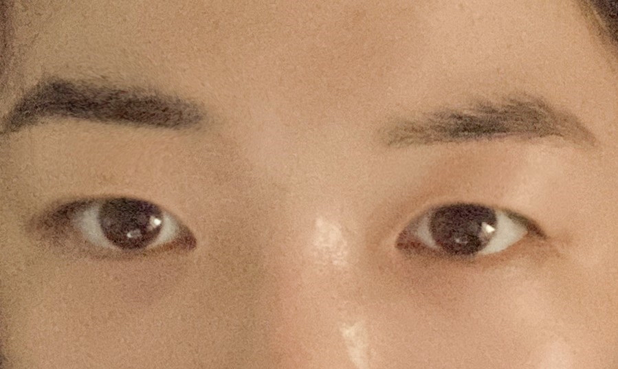 쌍꺼풀(매몰) 후기