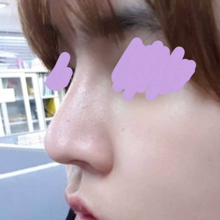 코재수술 후기