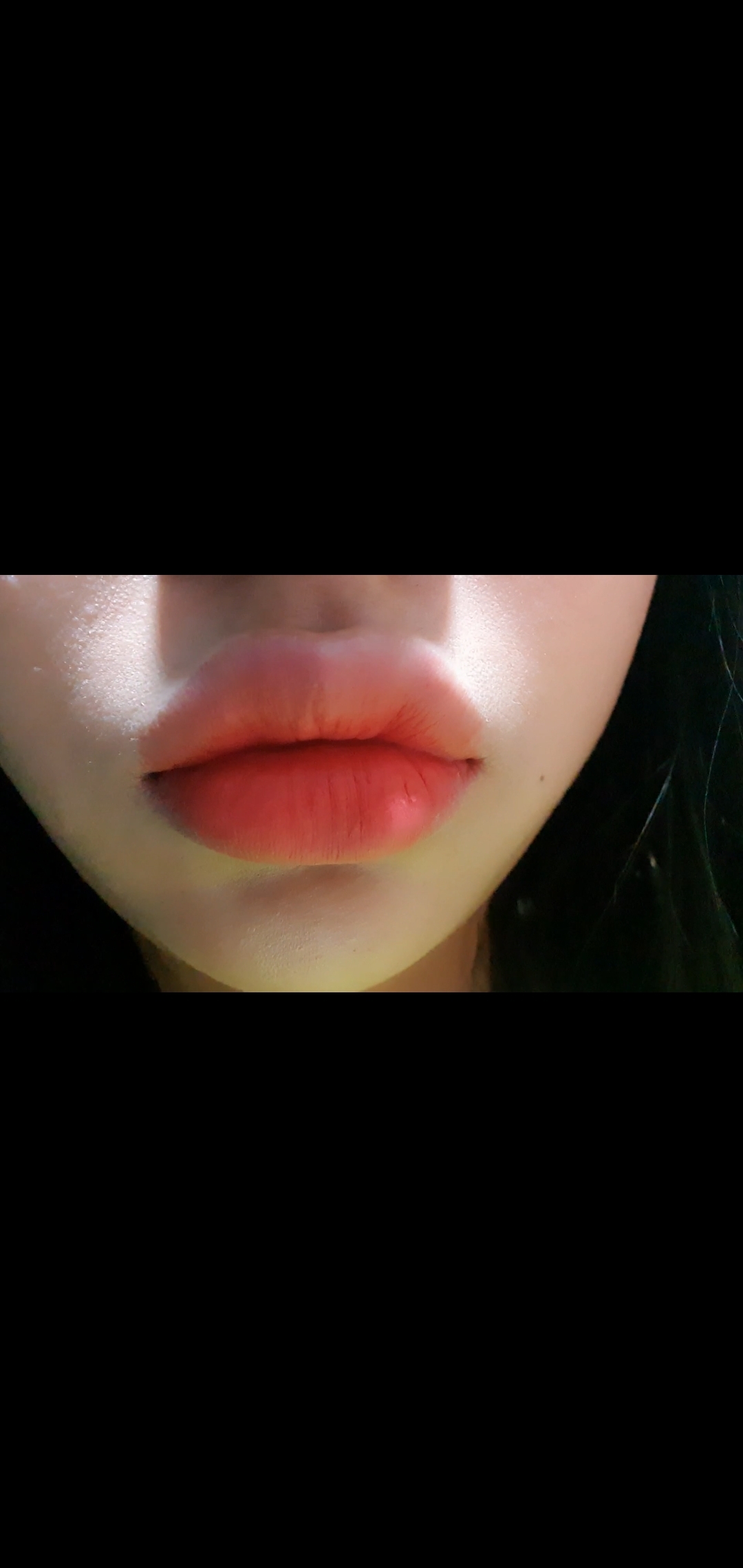 입술축소술 후기