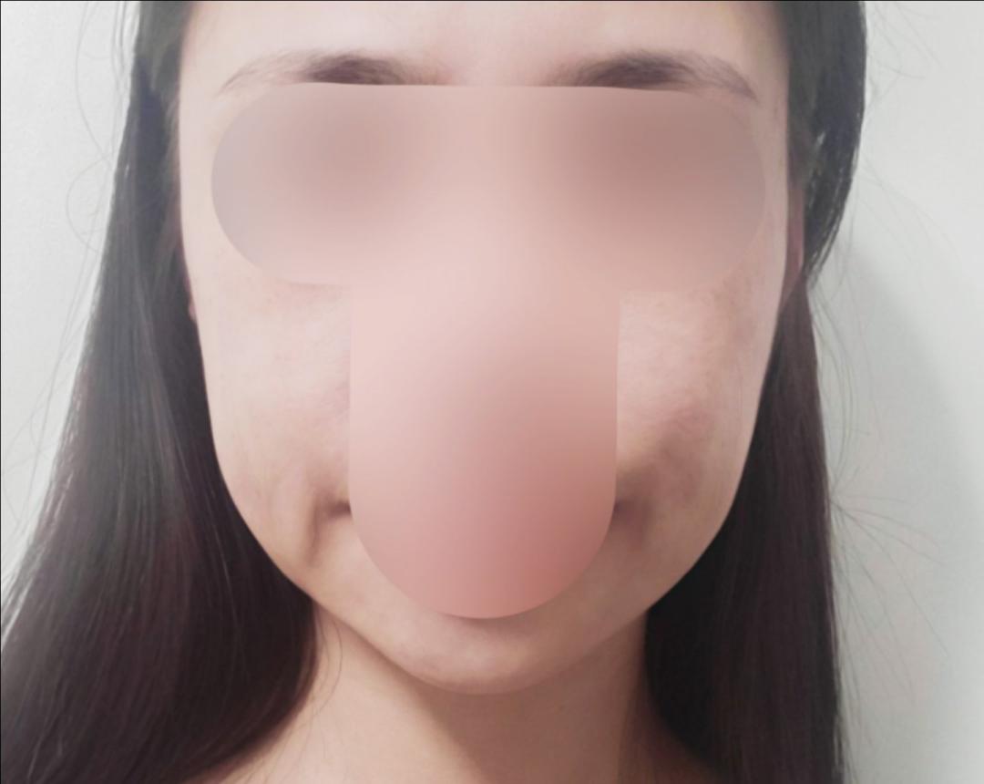 실리프팅 후기