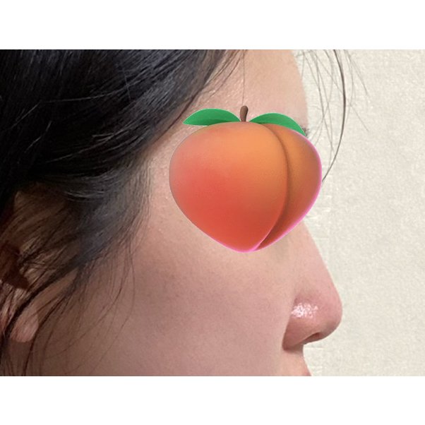 코끝(기증연골) 후기