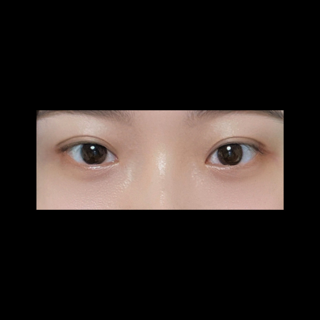 밑트임 후기