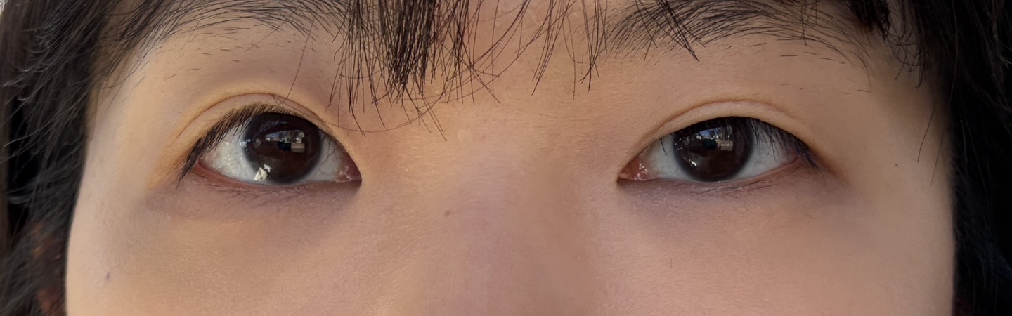 눈재수술 후기