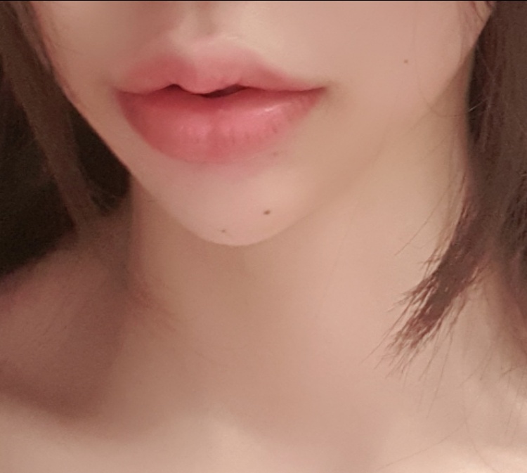 입꼬리성형 후기