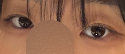 쌍꺼풀(절개) 후기