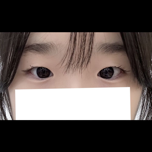 쌍꺼풀(자연유착) 후기