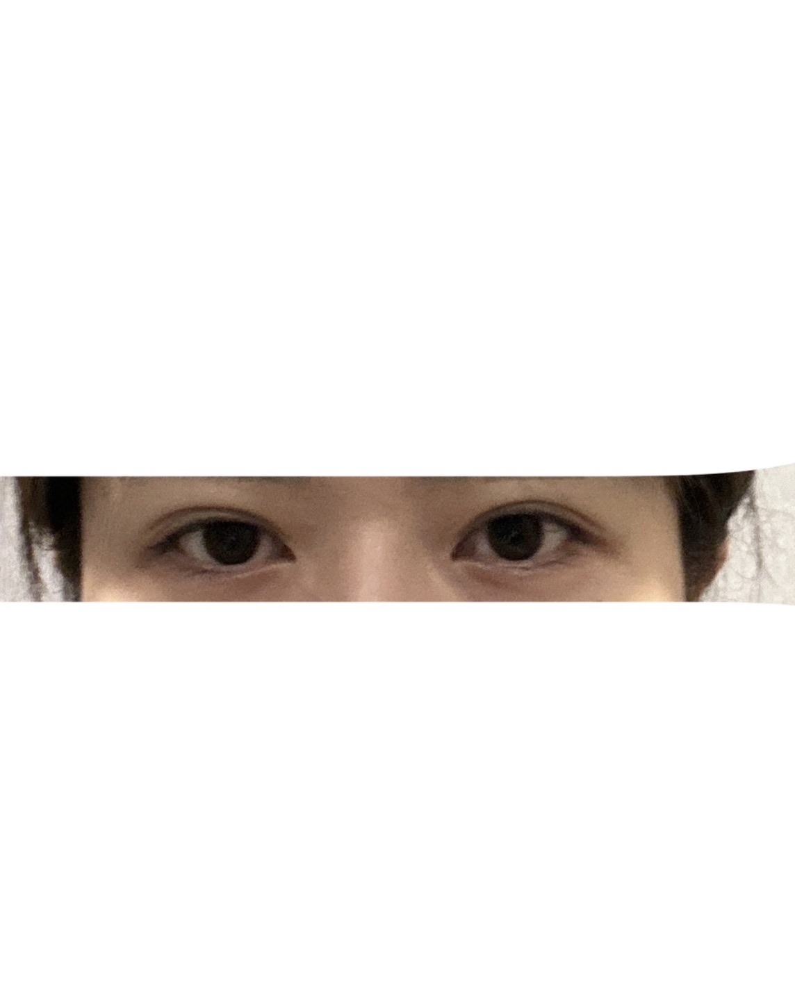 눈재수술 후기