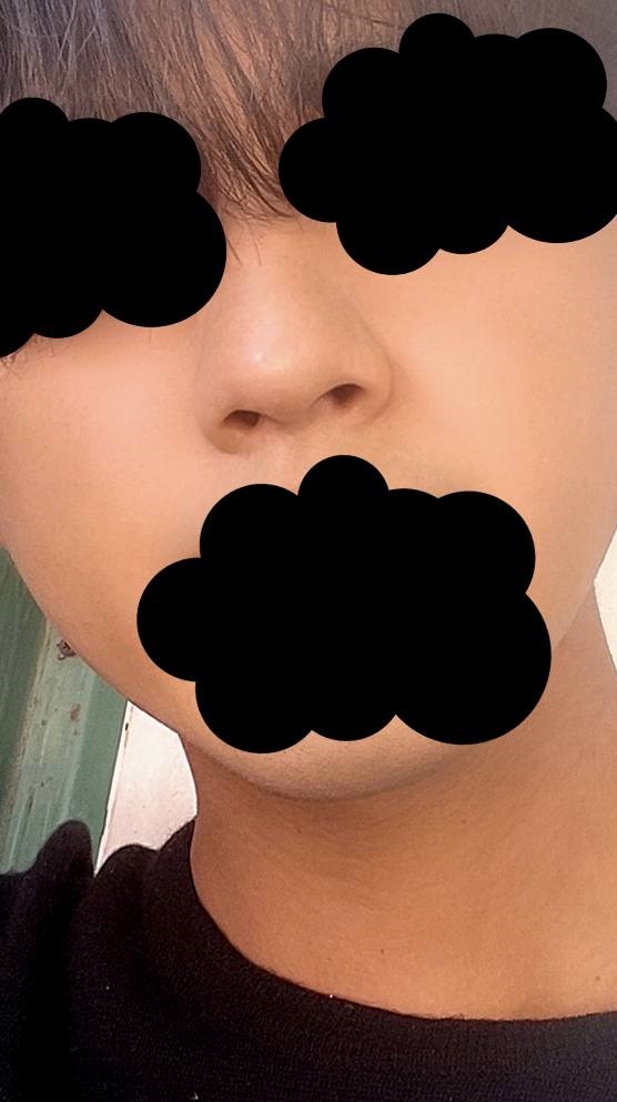콧대(자가조직) 후기