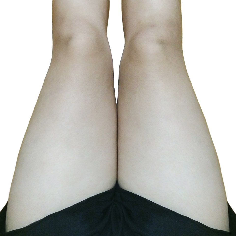 허벅지지방흡입 후기