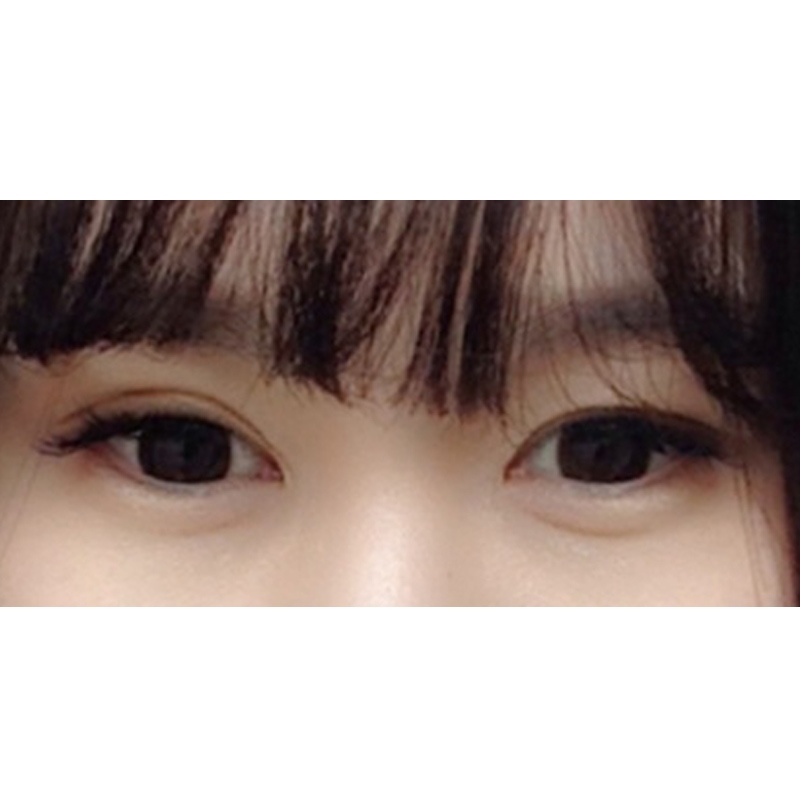 눈재수술 후기