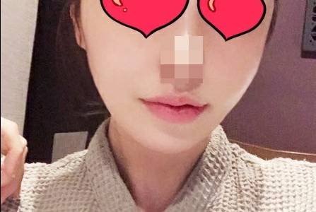 턱끝축소 후기