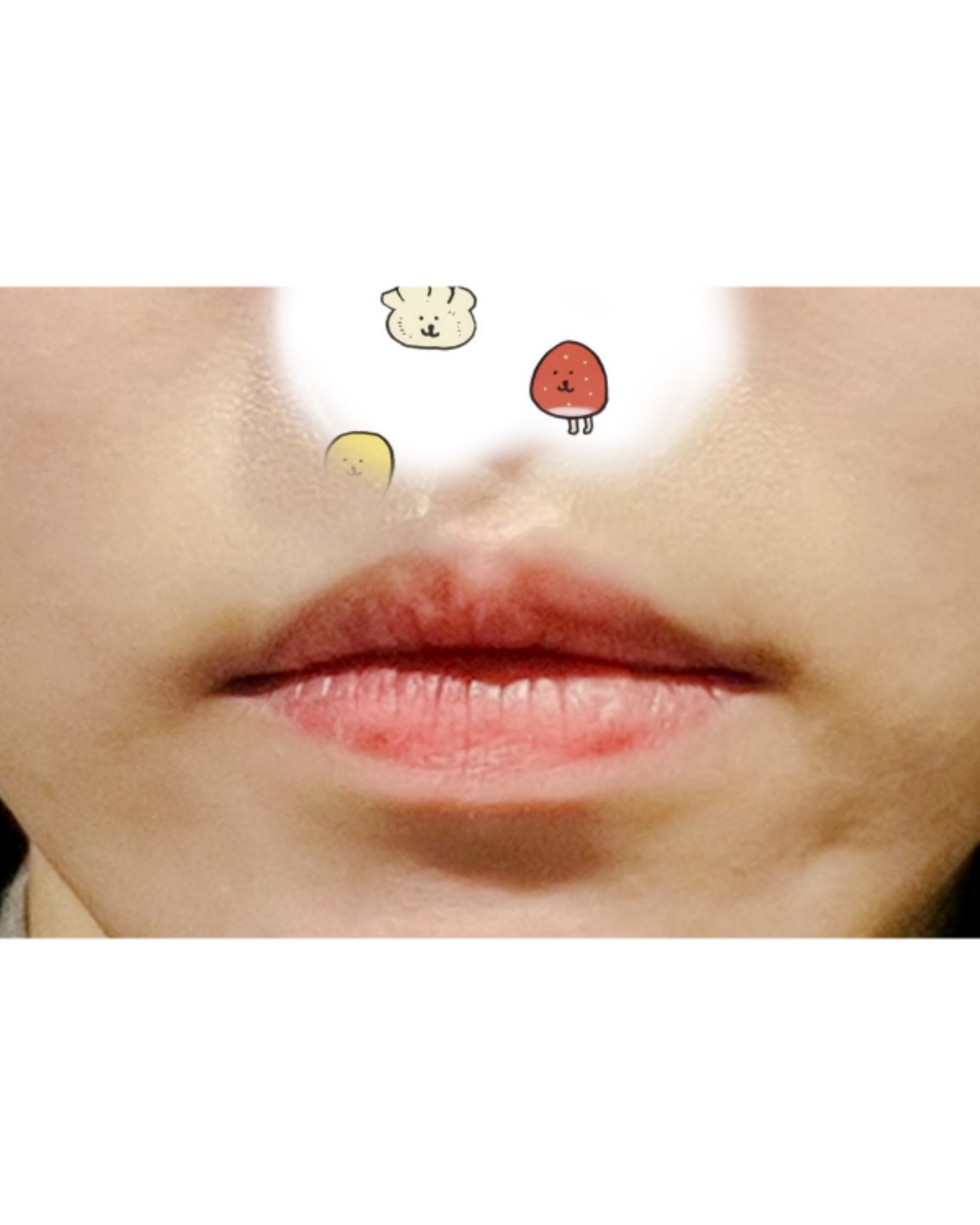 입꼬리성형 후기