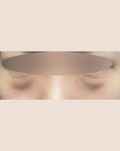 눈밑지방재배치 후기