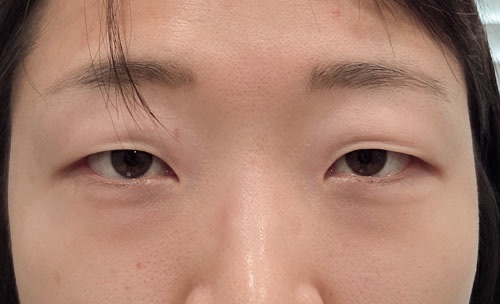 쌍꺼풀(자연유착) 후기
