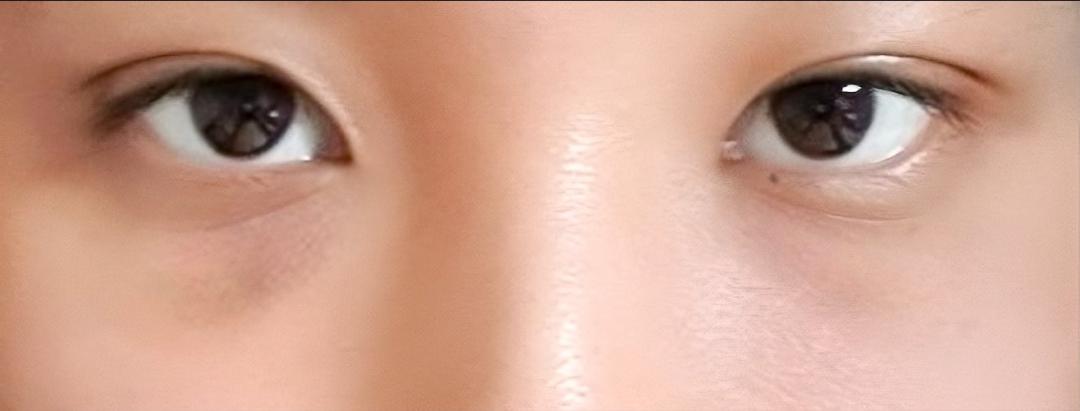 밑트임 후기