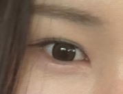 눈재수술 후기
