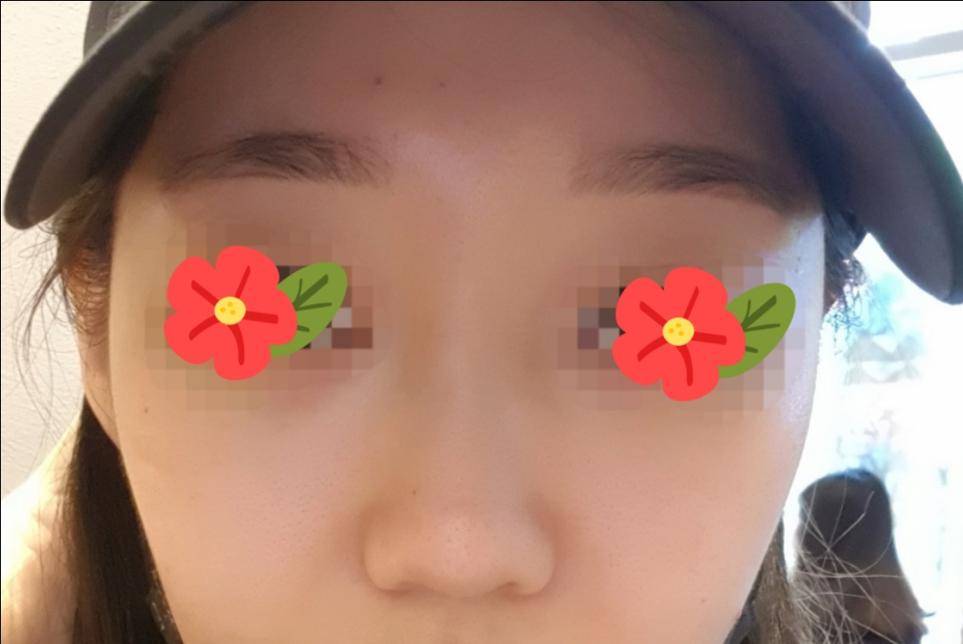 콧볼축소 후기