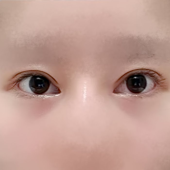 트임복원 후기