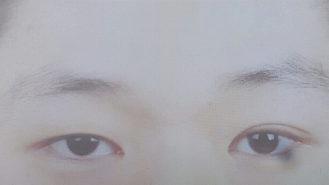 쌍꺼풀(절개) 후기