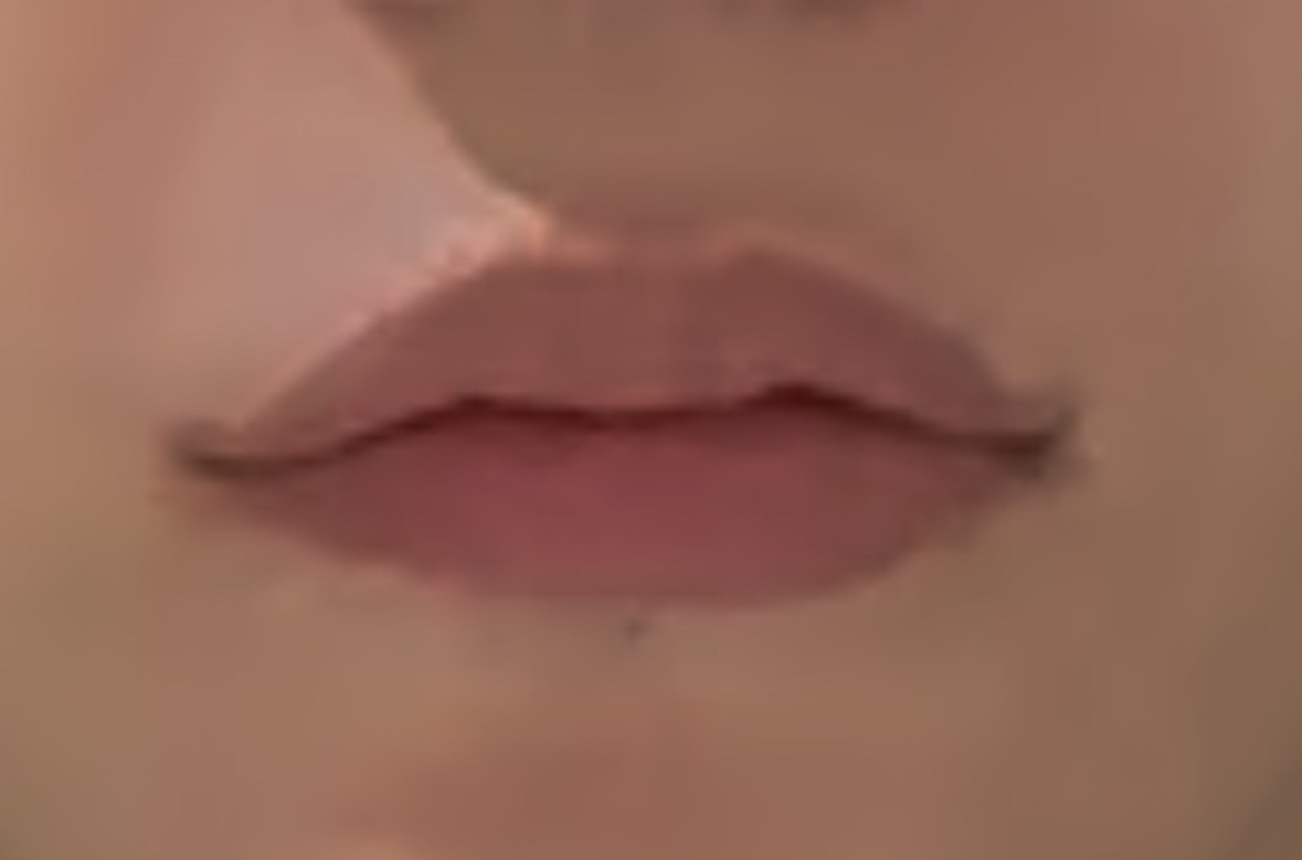 입꼬리성형 후기