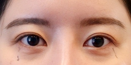 밑트임 후기