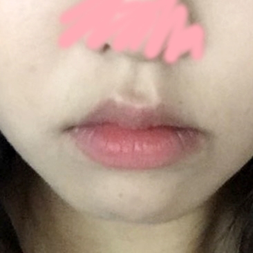 입꼬리성형 후기