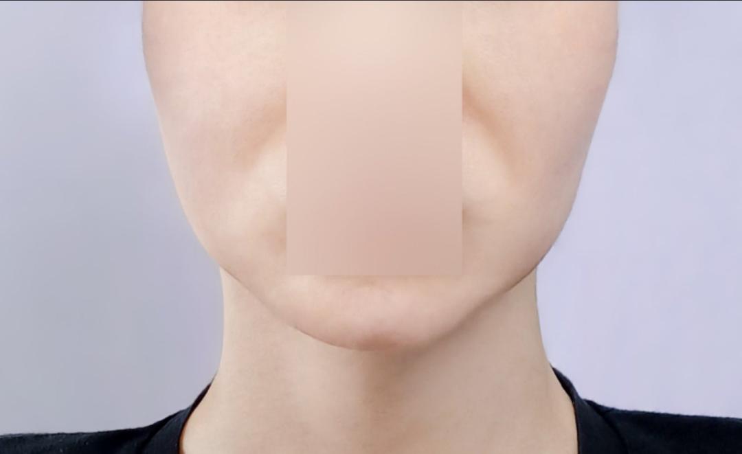 실리프팅 후기