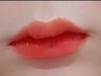입꼬리성형 후기