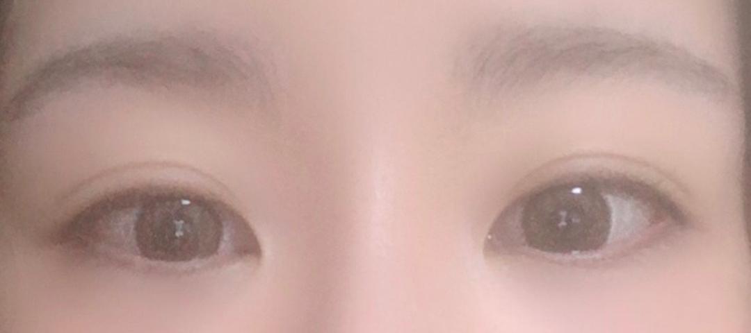 앞트임 후기