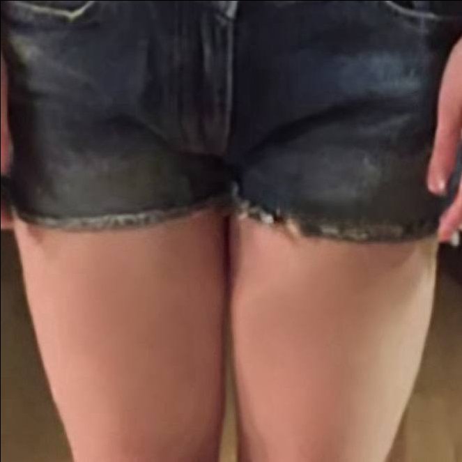 허벅지지방흡입 후기