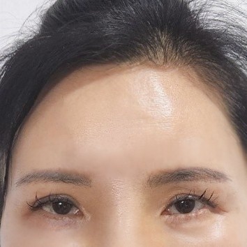 밑트임 후기