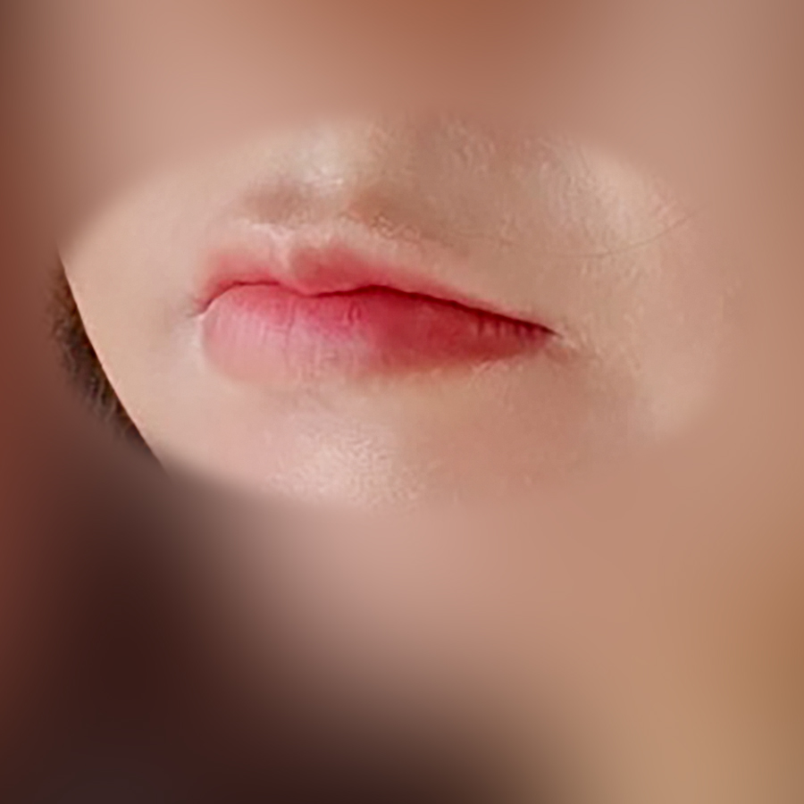 입꼬리성형 후기