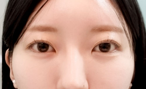 쌍꺼풀(자연유착) 후기
