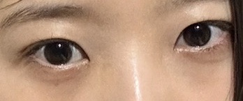 밑트임 후기
