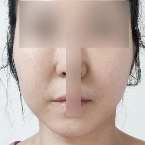 실리프팅 후기