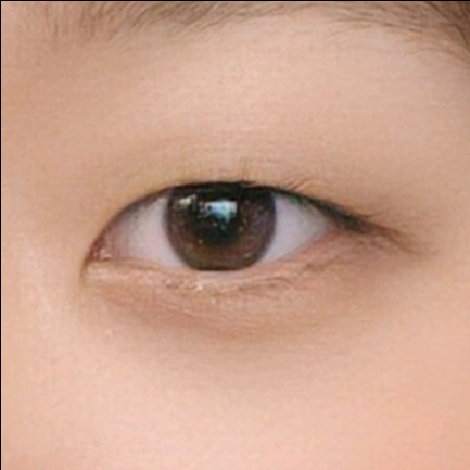 쌍꺼풀(절개) 후기