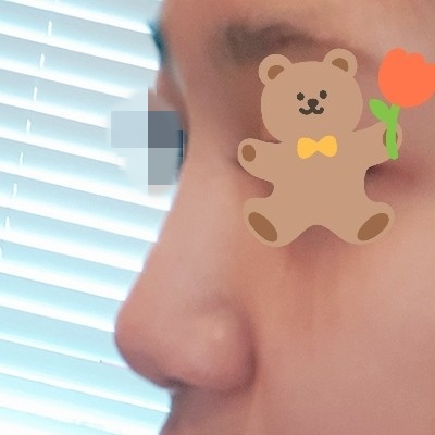 콧대(보형물) 후기