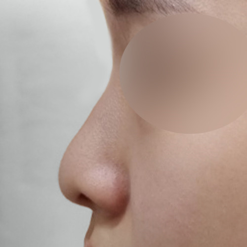 코끝(기증연골) 후기