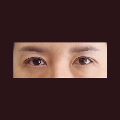 눈재수술 후기